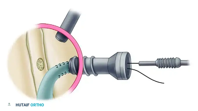 ARTHROSCOPIC BICEPS TENODESIS WITH A PERCUTANEOUS INTRAARTICULAR TENDON Surgical Diagram
