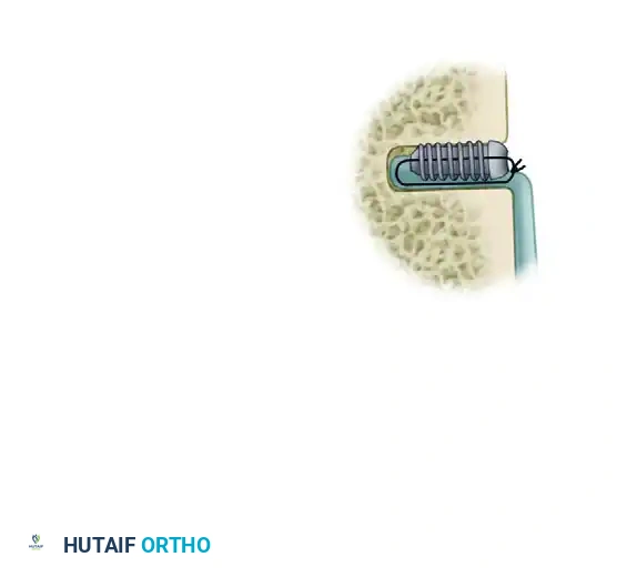 ARTHROSCOPIC BICEPS TENODESIS WITH A PERCUTANEOUS INTRAARTICULAR TENDON Surgical Diagram