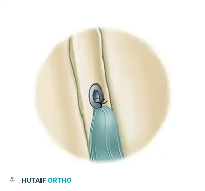 ARTHROSCOPIC BICEPS TENODESIS WITH A PERCUTANEOUS INTRAARTICULAR TENDON Surgical Diagram