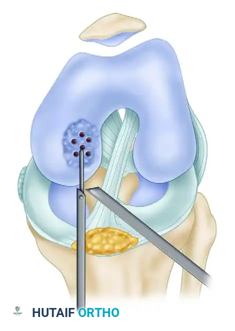 FIGURE 51-33 Technique for drilling intact lesion of osteo chondritis dissecans. Multiple perforations of lesion of medial femoral condyle are made using Kirschner wire through antero medial portal. SEE TECHNIQUE 51-13.