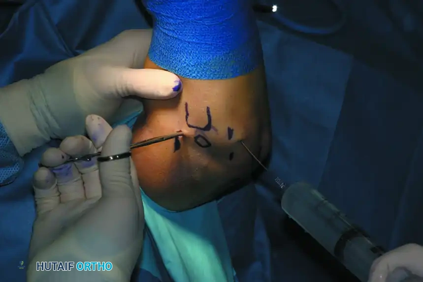 ARTHROSCOPIC ELBOW EXAMINATION Surgical Diagram