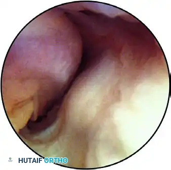 ARTHROSCOPIC ELBOW EXAMINATION Surgical Diagram
