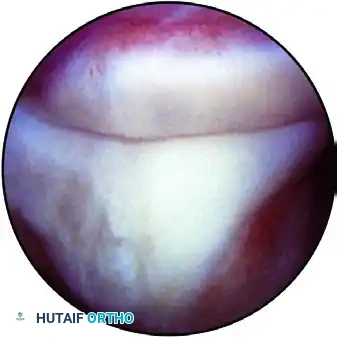 ARTHROSCOPIC ELBOW EXAMINATION Surgical Diagram