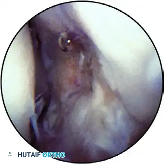 ARTHROSCOPIC ELBOW EXAMINATION Surgical Diagram