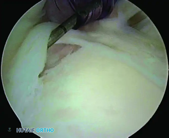 Arthroscopic Fixation of Type II SLAP Lesions: A Comprehensive Surgical Guide