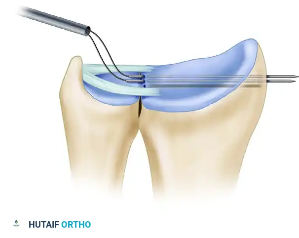 ARTHROSCOPIC REPAIR OF CLASS 1D INJURY Surgical Diagram