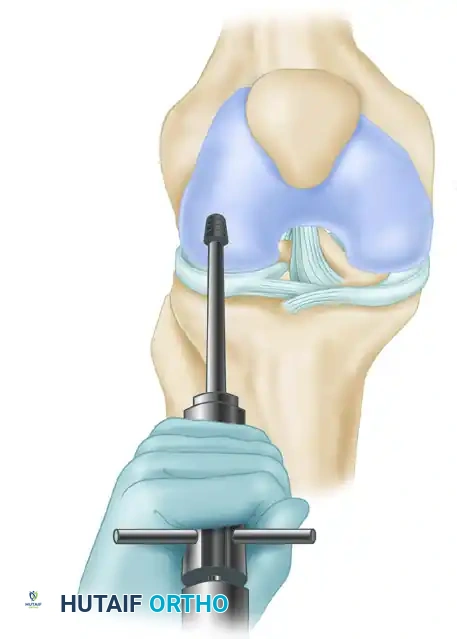 ARTHROSCOPIC SCREW FIXATION FOR OSTEOCHONDRITIS DISSECANS LESIONS IN THE MEDIAL FEMORAL CONDYLE Surgical Diagram