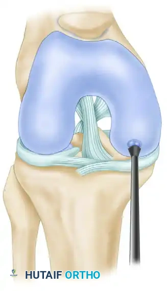 ARTHROSCOPIC SCREW FIXATION FOR OSTEOCHONDRITIS DISSECANS LESIONS IN THE MEDIAL FEMORAL CONDYLE Surgical Diagram