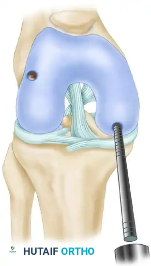 ARTHROSCOPIC SCREW FIXATION FOR OSTEOCHONDRITIS DISSECANS LESIONS IN THE MEDIAL FEMORAL CONDYLE Surgical Diagram