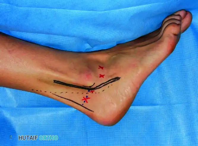 Arthroscopic Subtalar Arthrodesis: A Comprehensive Surgical Guide