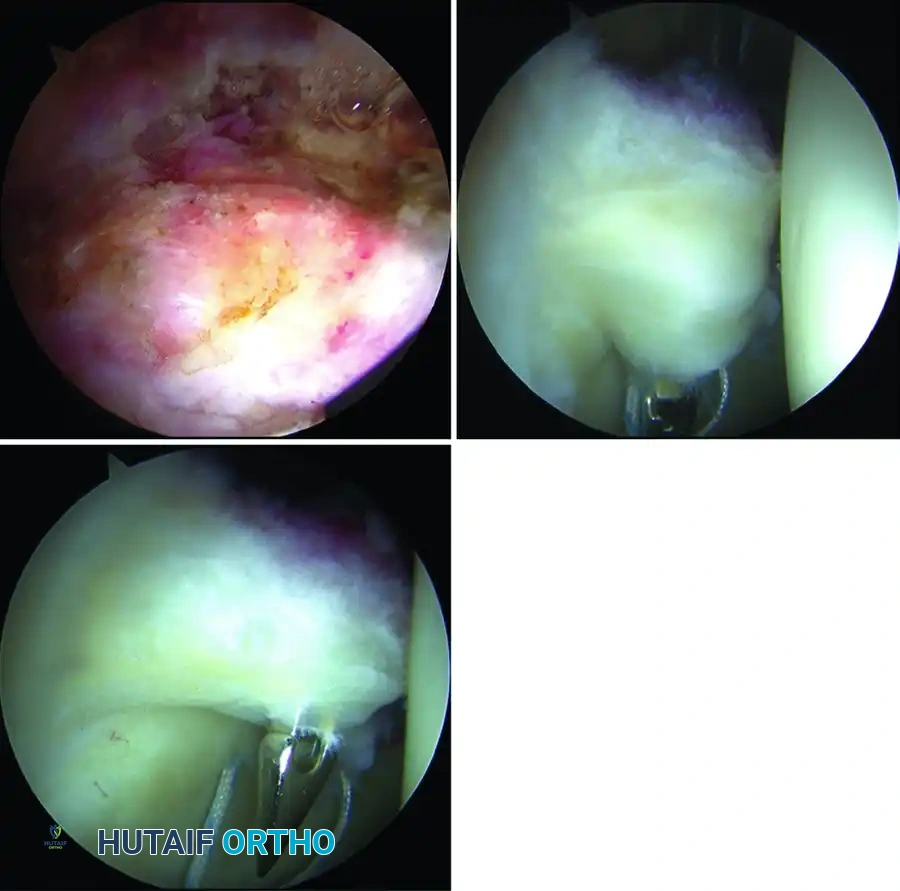 ARTHROSCOPIC TREATMENT OF PINCER IMPINGEMENT Surgical Diagram