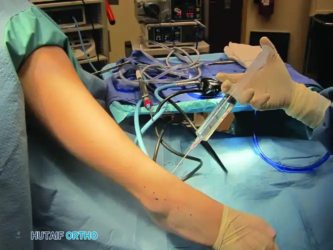 FIGURE 50-5 Anterolateral portal is made with blunt instru ment, followed by insertion of arthroscopic shaver. SEE TECH NIQUE 50-1.