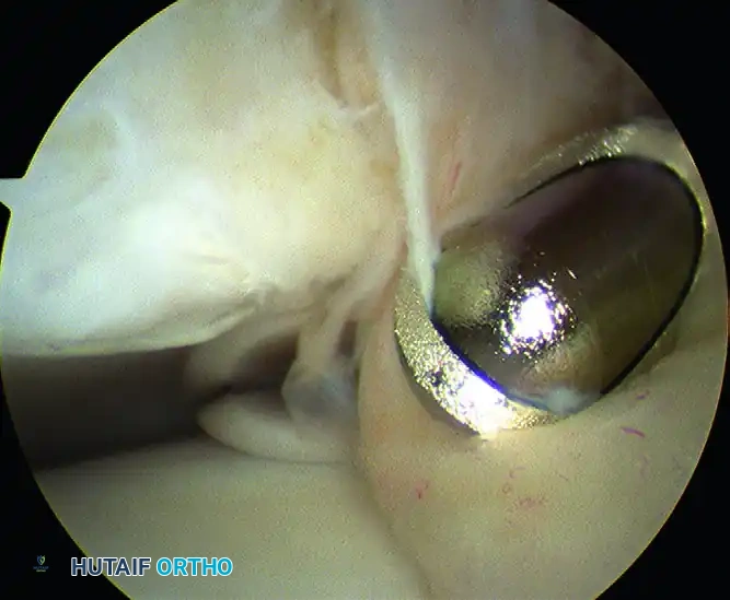 ARTHROSCOPY OF THE FOOT AND ANKLE Susan N. Ishikawa Surgical Diagram
