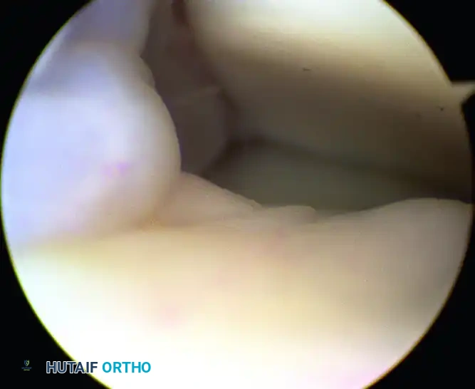 ARTHROSCOPY OF THE FOOT AND ANKLE Susan N. Ishikawa Surgical Diagram