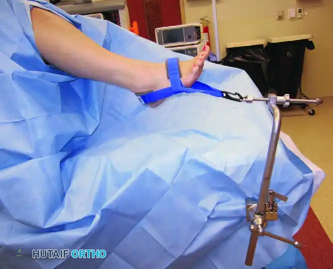 FIGURE 50-8 Noninvasive ankle distraction. SEE TECHNIQUE 50-1.