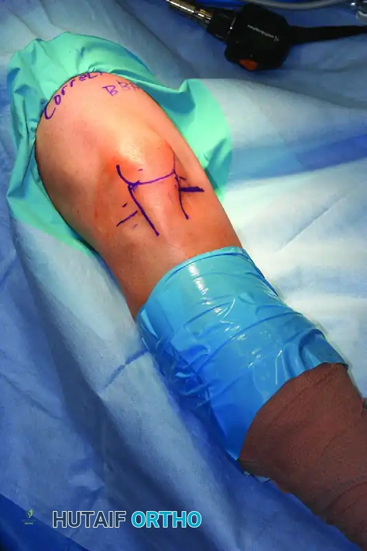 FIGURE 51-4 Landmarks drawn on knee before distention.
