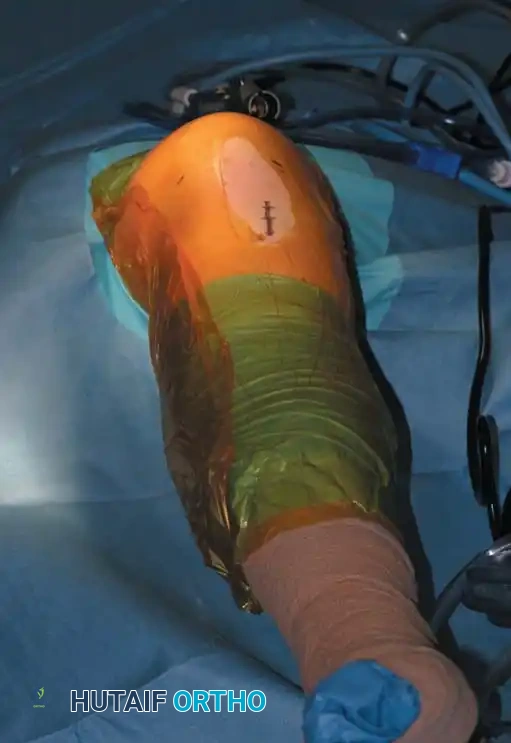 Fig. 48-2 Waterproof outer drape with central rubberized opening seals unsterile proximal thigh from operative fi eld.
