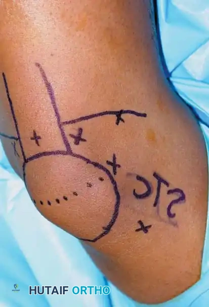 Fig. 48-4 Placement of lateral post and saline bag taped to table allow ease of leg positioning and full range of motion during ligament reconstruction.