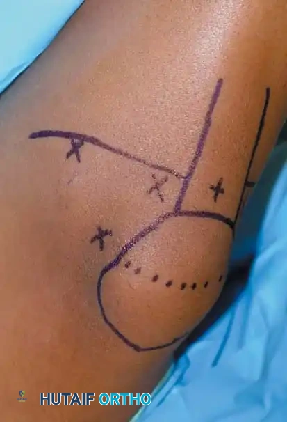 Fig. 48-4 Placement of lateral post and saline bag taped to table allow ease of leg positioning and full range of motion during ligament reconstruction.