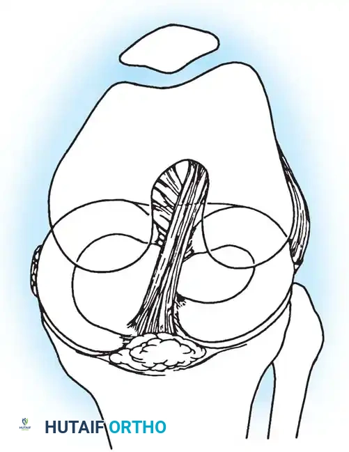 Popliteal tendon