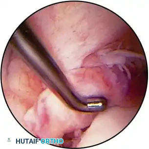 Torn lateral meniscus
