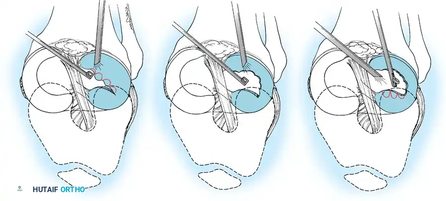 Arthroscopy of the Lower Extremity Surgical Diagram