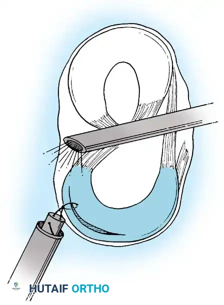 Fig. 48-33 All-inside technique. A, Proper posteromedial cannula placement begins outside and above medial hamstring tendons, above and behind posteromedial joint line, toward center of joint with knee fl exed 90 degrees. B, Suture placement through posterior operative cannula with suture hook while viewing with 70-degree arthroscope through intercondylar notch. C, Knot tying is accomplished with arthroscopic knot pusher, which advances sequential throws through posterior cannula while viewing with 70-degree arthroscope through intercondylar notch. (Redrawn from Morgan CD: Technical note. The “all-inside” meniscus repair, Op Tech Sports Med 2:201, 1994.)