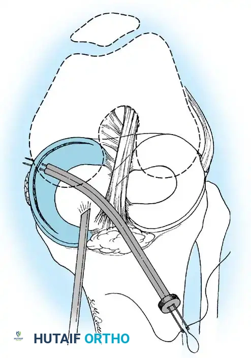 Fig. 48-32 Suture placement in midportion of large buckethandle tear using curved double-cannula technique.