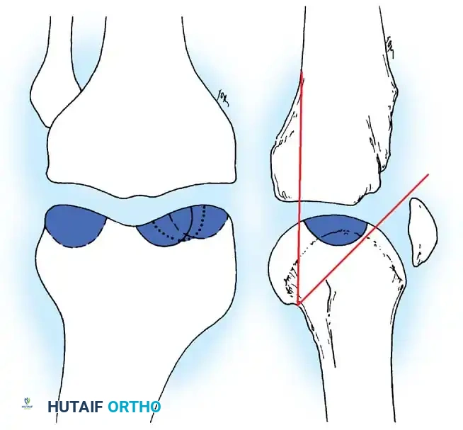 Fig. 48-37 Locations of lesions of osteochondritis dissecans. A, Locations of lesions of medial femoral condyle (central, laterocentral, or inferocentral) and of lateral femoral condyle (inferocentral and often posterior). B, Lateral view of medial femoral condyle showing common location of lesions. (From Shahriaree H: O’Connor’s textbook of arthroscopic surgery, Philadelphia, 1984, Lippincott.)