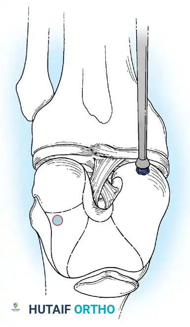 Fig. 48-40 A, Size of defect determined. B, Harvester driver extractor assembled with tube harvester and collared pin loaded. C, Harvester driven into subchondral bone. D and E, Harvesting of graft. F, Calibrated OATS alignment stick of appropriate diameter used to measure recipient socket depth and align angle of recipient socket correctly to position of insertion portal.