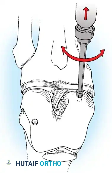 Fig. 48-40 A, Size of defect determined. B, Harvester driver extractor assembled with tube harvester and collared pin loaded. C, Harvester driven into subchondral bone. D and E, Harvesting of graft. F, Calibrated OATS alignment stick of appropriate diameter used to measure recipient socket depth and align angle of recipient socket correctly to position of insertion portal.