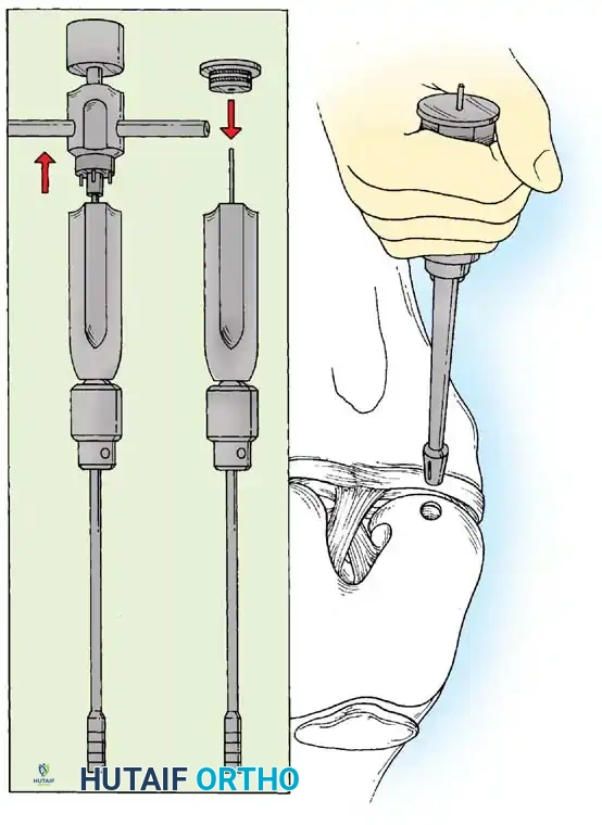 Fig. 48-40, cont’d G, Donor harvester, collared pin, and autograft core reinserted into driver. H, Donor tube harvester inserted into recipient socket. I, Sizer tamp, measuring 1 mm in diameter larger than bone core, positioned over bone core. J, Harvested and transferred cores. (Redrawn from Bobic V, Morgan CD: Osteochondral autograft transfer surgical technique manual, Arthrex, 2000, Naples, Fla.)