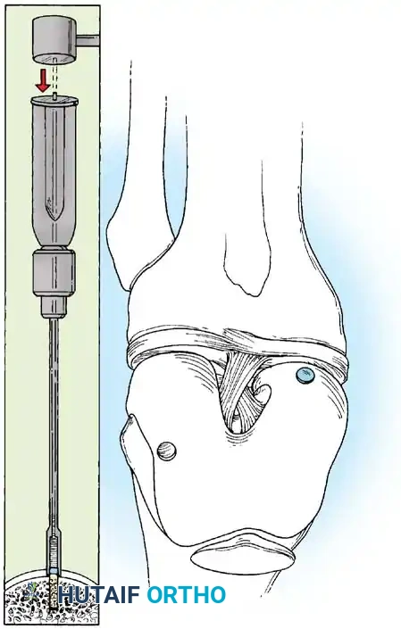 Fig. 48-40, cont’d G, Donor harvester, collared pin, and autograft core reinserted into driver. H, Donor tube harvester inserted into recipient socket. I, Sizer tamp, measuring 1 mm in diameter larger than bone core, positioned over bone core. J, Harvested and transferred cores. (Redrawn from Bobic V, Morgan CD: Osteochondral autograft transfer surgical technique manual, Arthrex, 2000, Naples, Fla.)