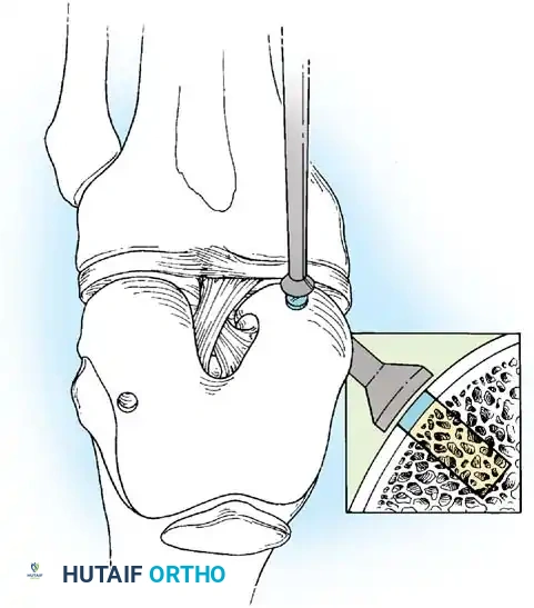 Fig. 48-40, cont’d G, Donor harvester, collared pin, and autograft core reinserted into driver. H, Donor tube harvester inserted into recipient socket. I, Sizer tamp, measuring 1 mm in diameter larger than bone core, positioned over bone core. J, Harvested and transferred cores. (Redrawn from Bobic V, Morgan CD: Osteochondral autograft transfer surgical technique manual, Arthrex, 2000, Naples, Fla.)