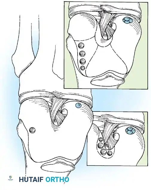 Arthroscopy of the Lower Extremity Surgical Diagram
