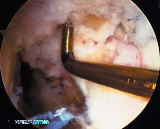 1-2 mm posterior wall Slope of medial tibial spine