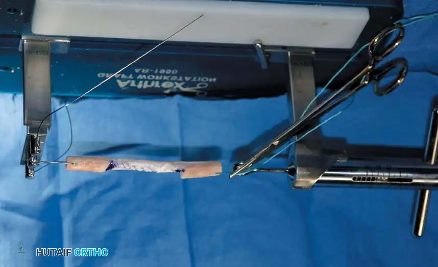 Arthroscopy of the Lower Extremity Surgical Diagram