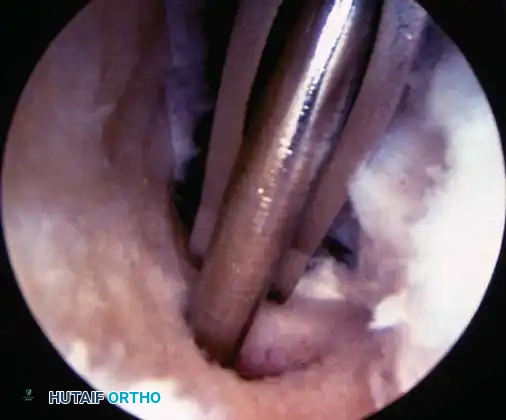 Fig. 48-44, cont’d G, Tibial tunnel should be posterior to roof of altered intercondylar notch to prevent graft impingement in knee extension. H, Use of 7-mm femoral offset guide to assist with femoral guidewire placement. I, Derotation slot at 12-o’clock position on femoral tunnel to allow guidewire placement and viewing of recessed graft and to prevent posterior migration of interference screw. J, Use of probe to guide graft into femoral tunnel, with cancellous portion of graft directly anterior. K, With knee fl exed more than 100 degrees, guidewire is placed up femoral tunnel through middle cannula. Interference screw is passed, ensuring that guidewire and traction suture is a straight line and ensuring minimal divergence between screw and bone plug. L, Use of sheath to protect graft and to assist in placing screw parallel to graft.