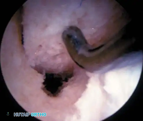 Fig. 48-44, cont’d G, Tibial tunnel should be posterior to roof of altered intercondylar notch to prevent graft impingement in knee extension. H, Use of 7-mm femoral offset guide to assist with femoral guidewire placement. I, Derotation slot at 12-o’clock position on femoral tunnel to allow guidewire placement and viewing of recessed graft and to prevent posterior migration of interference screw. J, Use of probe to guide graft into femoral tunnel, with cancellous portion of graft directly anterior. K, With knee fl exed more than 100 degrees, guidewire is placed up femoral tunnel through middle cannula. Interference screw is passed, ensuring that guidewire and traction suture is a straight line and ensuring minimal divergence between screw and bone plug. L, Use of sheath to protect graft and to assist in placing screw parallel to graft.