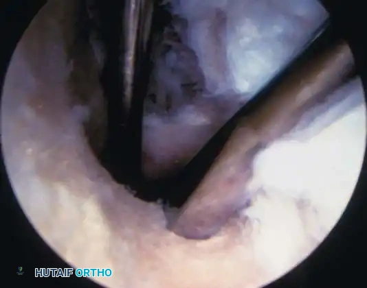 Fig. 48-44, cont’d G, Tibial tunnel should be posterior to roof of altered intercondylar notch to prevent graft impingement in knee extension. H, Use of 7-mm femoral offset guide to assist with femoral guidewire placement. I, Derotation slot at 12-o’clock position on femoral tunnel to allow guidewire placement and viewing of recessed graft and to prevent posterior migration of interference screw. J, Use of probe to guide graft into femoral tunnel, with cancellous portion of graft directly anterior. K, With knee fl exed more than 100 degrees, guidewire is placed up femoral tunnel through middle cannula. Interference screw is passed, ensuring that guidewire and traction suture is a straight line and ensuring minimal divergence between screw and bone plug. L, Use of sheath to protect graft and to assist in placing screw parallel to graft.