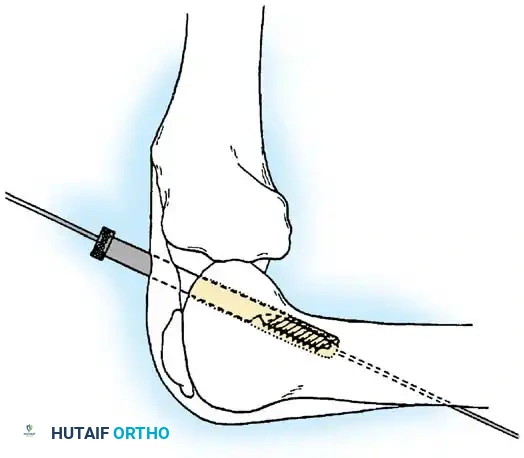 Arthroscopy of the Lower Extremity Surgical Diagram