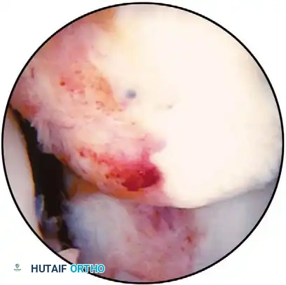 Fig. 48-45 A, Calcifi ed stump of anterior cruciate ligament after chronic tear. B, Empty lateral wall sign indicating anterior cruciate ligament–defi cient knee; anterior cruciate ligament can be attached to posterior cruciate ligament, giving false indication of functional ligament.