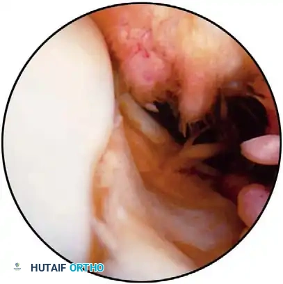 Fig. 48-45 A, Calcifi ed stump of anterior cruciate ligament after chronic tear. B, Empty lateral wall sign indicating anterior cruciate ligament–defi cient knee; anterior cruciate ligament can be attached to posterior cruciate ligament, giving false indication of functional ligament.