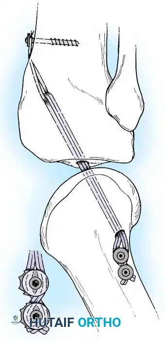 Arthroscopy of the Lower Extremity Surgical Diagram
