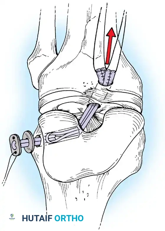 Arthroscopy of the Lower Extremity Surgical Diagram