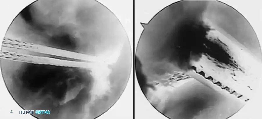 Fig. 48-51 A, Technique of physeal-sparing, combined intraarticular and extraarticular reconstruction of anterior cruciate ligament with use of autogenous iliotibial bone graft. A, Iliotibial band harvested through oblique lateral knee incision. B, Iliotibial band graft detached proximally, left attached distally, and dissected free from lateral patellar retinaculum. C, Iliotibial band graft brought through knee with use of full-length clamp placed from anteromedial portal through over-top position into lateral incision. D, Graft brought through over-top position. E, Clamp is placed from proximal medial incision in leg under intermeniscal ligament, and groove is made in anteromedial tibial epiphysis with use of rasp.