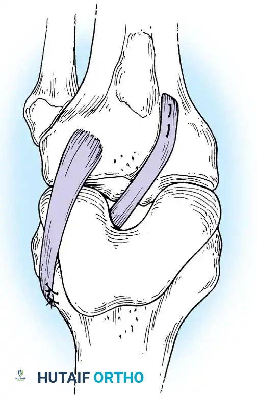 Arthroscopy of the Lower Extremity Surgical Diagram