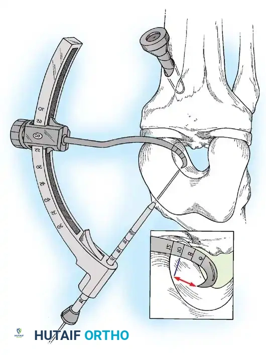 Arthroscopy of the Lower Extremity Surgical Diagram