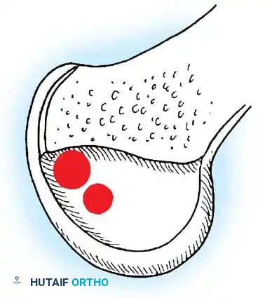 Fig. 48-53 Ideal sites for positions of femoral tunnels as viewed from side of left knee with lateral femoral condyle removed. (Redrawn from Bisson L, Clancy W: Isolated PCL injury and posterolateral laxity. In Chapman MW, Szabo RM, Marder RA, et al, eds: Operative orthopaedics, 3rd ed, Philadelphia, 2000, Lippincott Williams & Wilkins.)