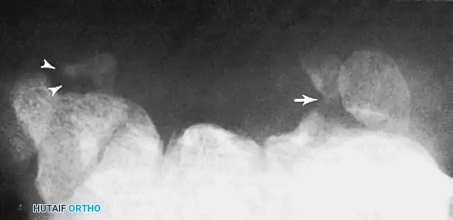FIGURE 69-11 Carpal tunnel view shows avulsion fracture of hamate hook (arrow) and trapezium (arrowheads).